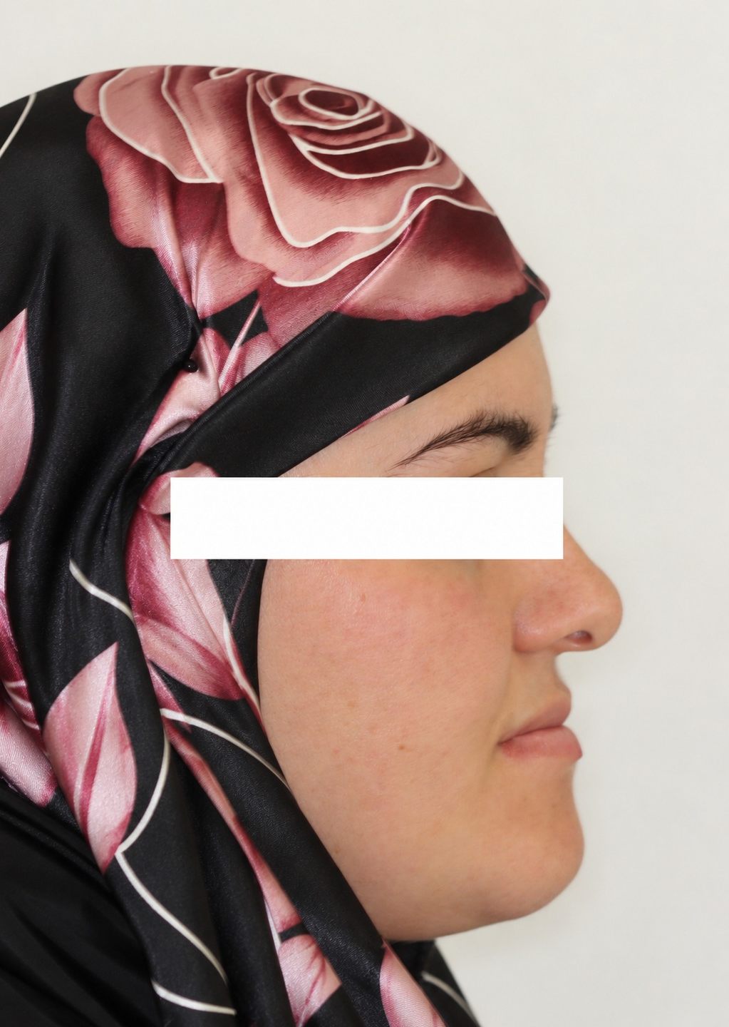 Before treatment