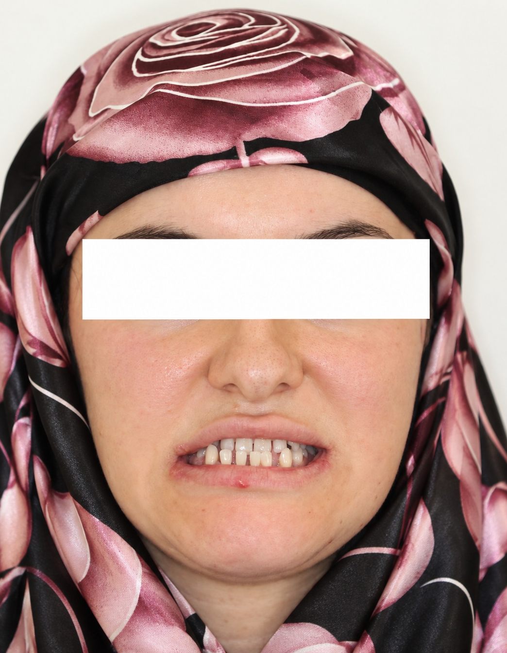 Before treatment