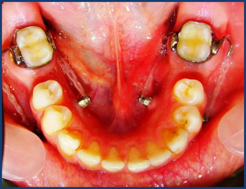 The two anchorage heads in clinical use, connected to a lingual wire for lower second molar protraction.